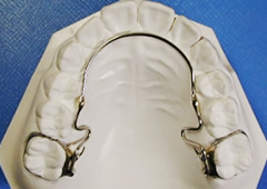 歯列を拡大する装置 リンガルアーチ