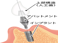 インプラントについて