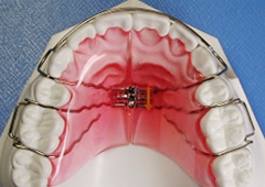 歯列を拡大する装置 拡大床
