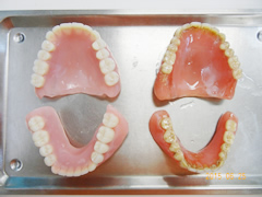 LBO理論、咬合調整の総義歯(入れ歯)比較1