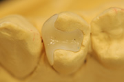 ポーセレンインレー(セレック使用)